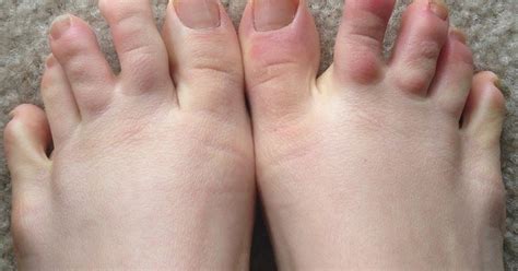 Rash On Hands Infected Toe Middle Toe Purple Toes Red Rash Itchy