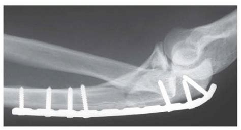 Open Reduction And Internal Fixation Of Fractures Of The Proximal Ulna Musculoskeletal Key
