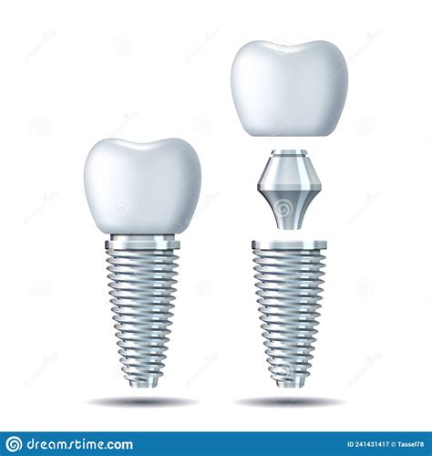 Implante Vectorial 3d De Diente Blanco Realista Icono De Dentadura