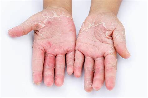 Hand Dermatitis In Two Thirds Of Public Due To Frequent Hand Washing During COVID