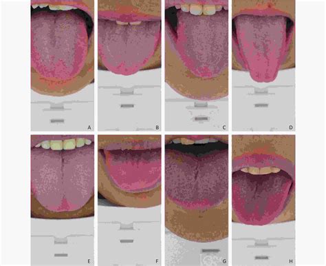 Diagnosis Of Early Esophageal Cancer Based On Tcm Tongue Inspection