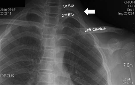 Juvenile First Rib Fracture Caused By Morning Stretching Journal Of