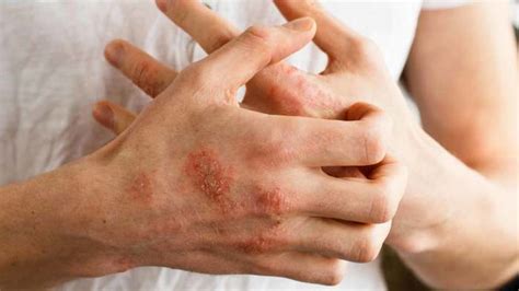 How To Tell If You Have Eczema Or Psoriasis And How To Get Rid Of Both