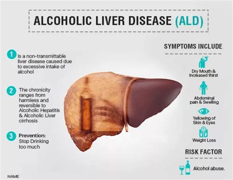 Alchoholic Liver Diseases Symptoms And Best Treatment Ailbs India