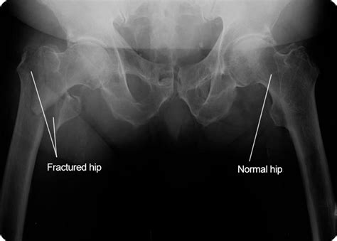 Hip Fractures Orthoanswer