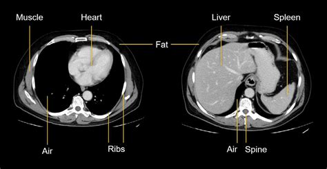 Abdominal Ct Basics • Litfl • Radiology Library