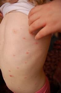 See full list on mayoclinic.org Chicken Pox Stages Pictures, Photos, Images | Chicken Pox ...
