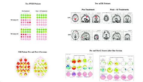 Examples Of Reduced Z Score Values In Eeg Brain Maps In Six Different
