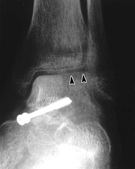 Partial Hawkins Sign In Fractures Of The Talus A Report Of Three Cases