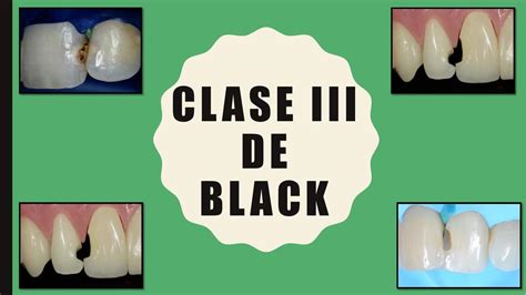 Clasificación De Black Clase Iii Tati Dent Udocz