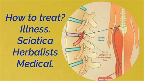 Sciatica Treatment And Sciatic Nerve Inflammation With Medicinal