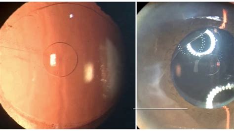Phacoemulsification Cataract Surgery With Extended Depth Of Focus EDOF Intraocular Lens