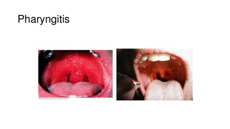 Pharyngitis Laryngitis