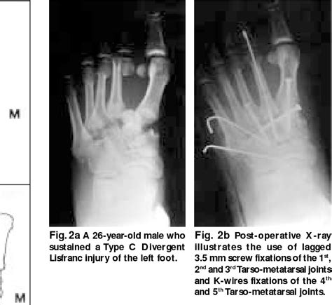 Figure 1 From Open Reduction And Temporary Rigid Internal Fixation Of