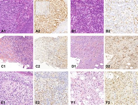 A1 Cutaneous Localization Of Rosai Dorfman Disease With Emperipolesis