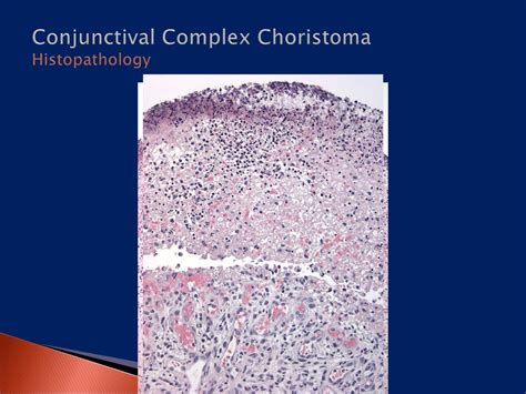 Conjunctival Complex Choristoma Ppt Download