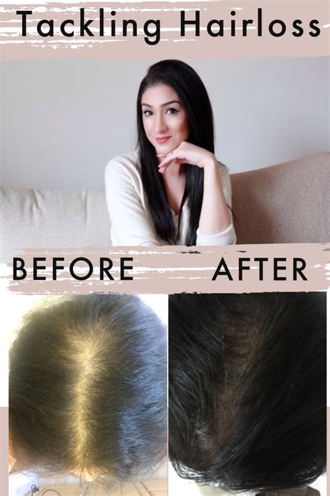 Vitamin D Hair Growth Before And After A Bennie Sims