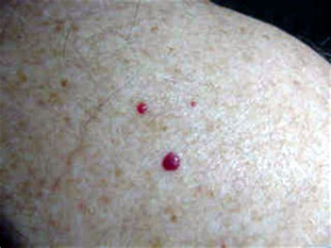 Cherry angioma is a common skin condition that affects individuals over 30 years of age. Do Angiomas Need To Be Treated or Left Alone on the Skin?