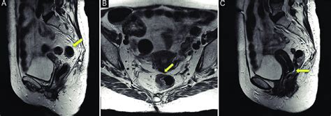 A The Sigmoid Take Off Shown On A Sagittal T2 W Magnetic Resonance