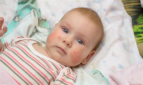The Most Important Thing You Can Do To Help Your Babys Eczema