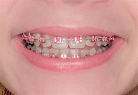 Pink Braces Whats The Right Color For You Fun Footer