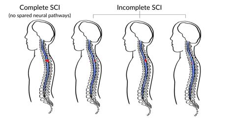 C4 Spinal Cord Injury What To Expect And How To Recover