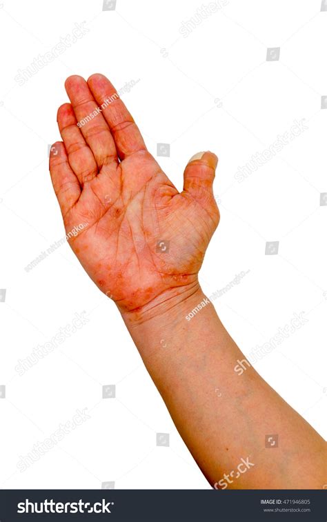 Hand Blister Caused By Allergies Isolated Stock Photo 471946805