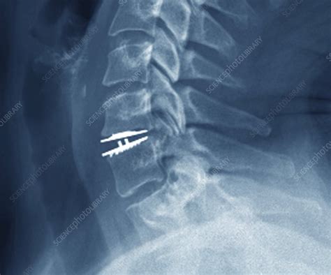 Cervical Intervertebral Disc Implant X Ray Stock Image C0403334