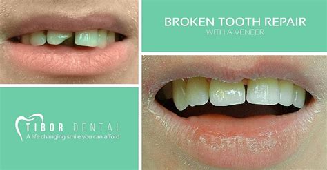 This Man Had Lost Part Of A Front Tooth In An Accident For This Reason A Veneer Matching His