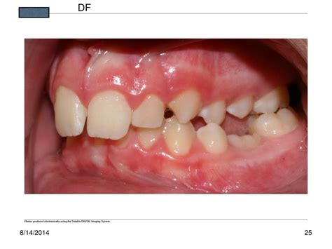 Ppt Ankylosis And Retained Primary Teeth Powerpoint Presentation Free