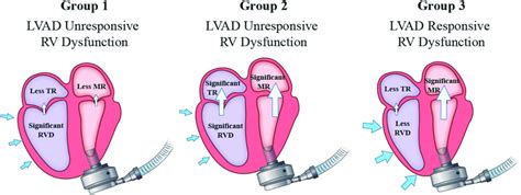 Post Lvad Implantation Echocardiographic Findings On Atrioventricular