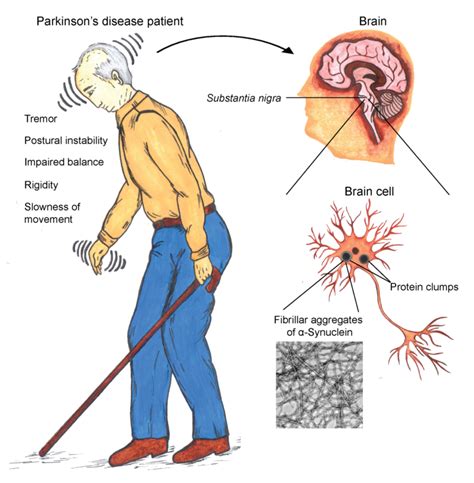 Parkinsons Disease Cause Symptoms Diagnosis Treatment Exercise