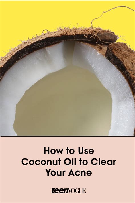 Coconut Oil For Acne Learn How It Can Help Clear Your Skin Coconut