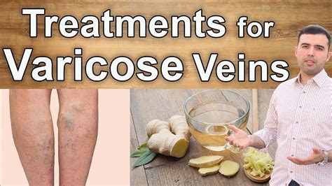 Natural Cures For Varicose Veins 10 Best Supplements Herbs And Diets