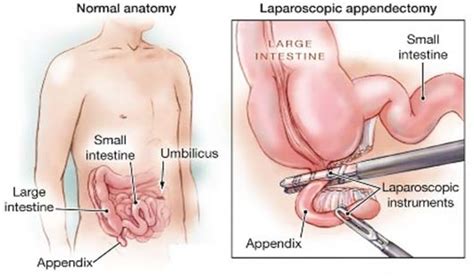 Eergister kreeg ik ineens erge buikpijn. How long does it take to recover from laparoscopic surgery ...