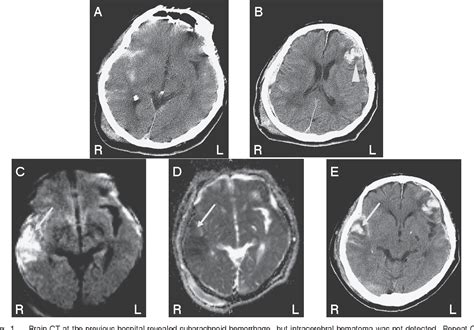 Figure 1 From The Usefulness Of Ct Diffusion Weighted Image Mismatch In