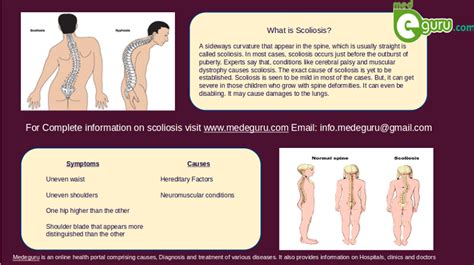 What Is Scoliosis Images Causes Symptoms And Surgerymed E Guru