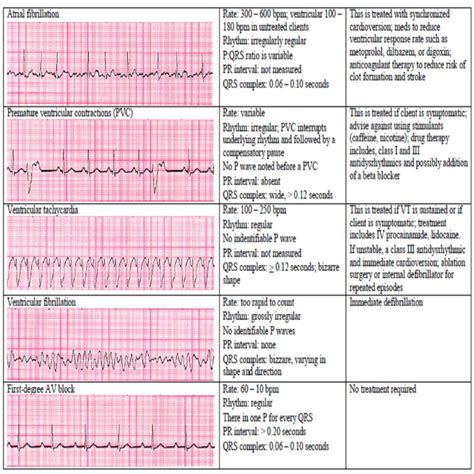 13 Cardiac Rhythm And Dysrhythmias Cheat Sheet Any Nurse