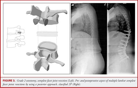 Pdf The Comprehensive Anatomical Spinal Osteotomy Classification