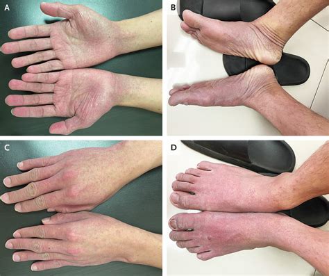 Papularpurpuric “gloves And Socks” Syndrome In Parvovirus B19