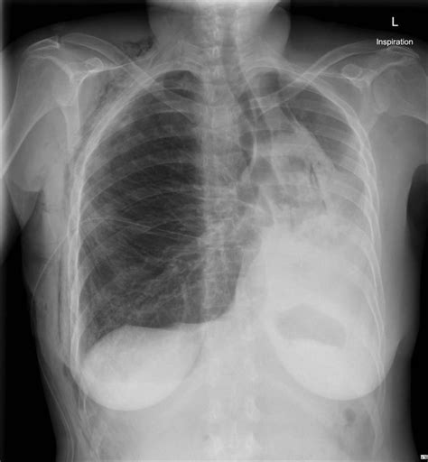 Lung Collapse Case 1 • Litfl • Ultrasound Library Clinical Case