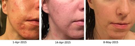 How I Cured My Seborrheic Dermatitis Acne Hubpages