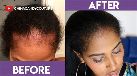 Yes, of course, it will grow back. HOW TO GROW EDGES BACK FAST | NATURAL HAIR | POSTPARTUM ...