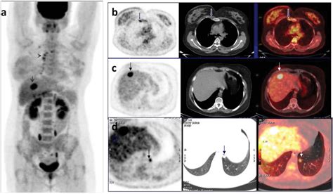 Clinical Impact Of 18f Fdg Petct On Initial Staging And Therapy