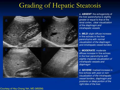 Stages Of Hepatic Steatosis