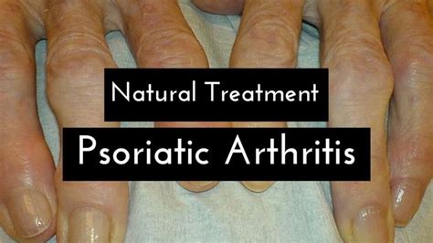 What Are The Main Causes Of Psoriatic Arthritis Psoriatic Arthritis