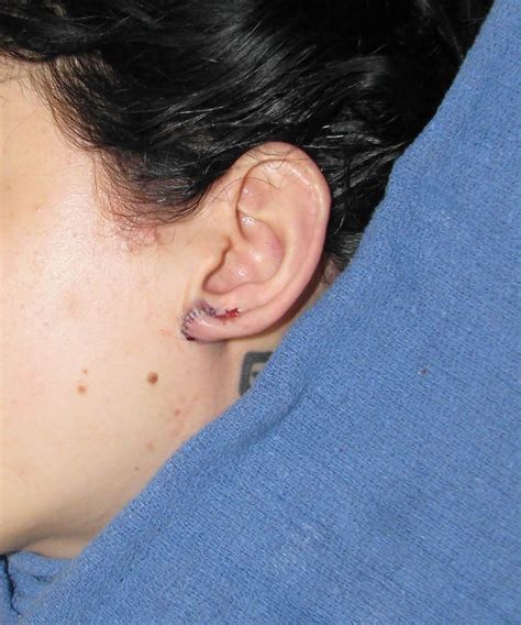 San Diego Plastic Surgery Of The Ear Reshaping Surgery Otoplasty