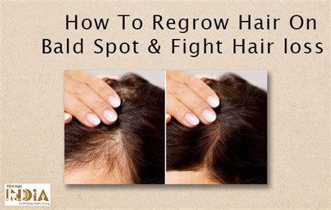 How To Regrow Hair On Bald Spot And Fight Hair Loss