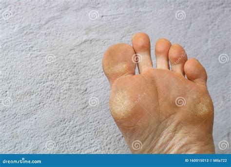 Dry Skin Plantar Callosity And Flakes On The Female Feet Sole Stock