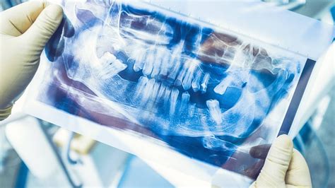 Replacing Missing Teeth Minneapolis Oral Surgeons Minnesota Oral Facial Surgery